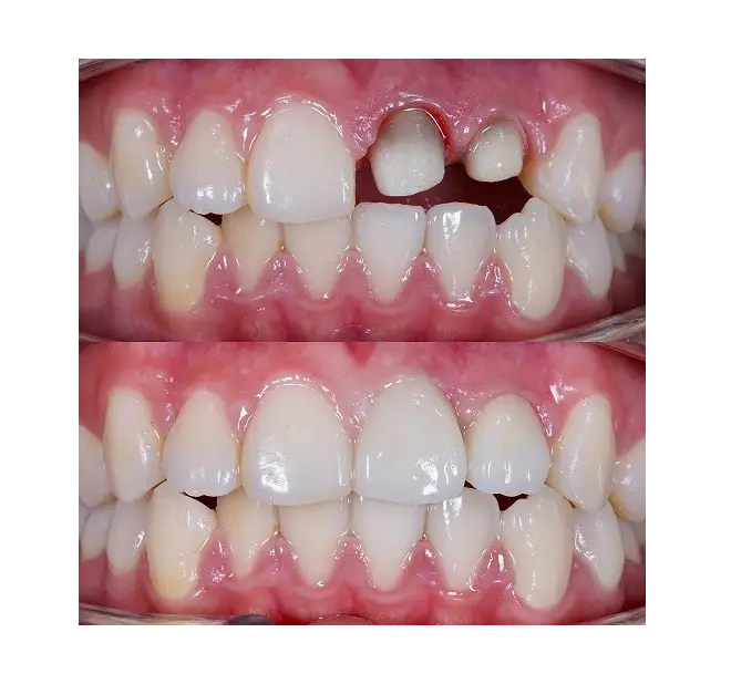 tooth crown before and after results of patient 